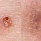 skin-cancer-1